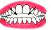 open bite