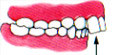 protruding upper bite