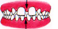 spacing teeth